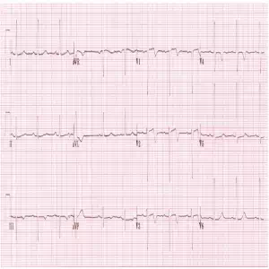 STEMI equiv 4 Wellens-Type-A